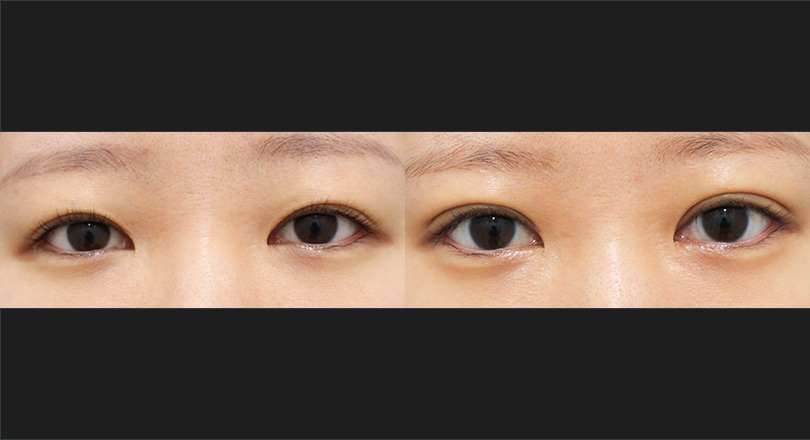 눈성형 전후사진 (자연유착, 눈썹하거상)