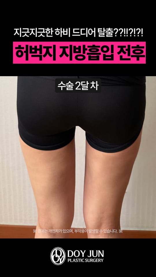 허벅지 지방흡입 전후